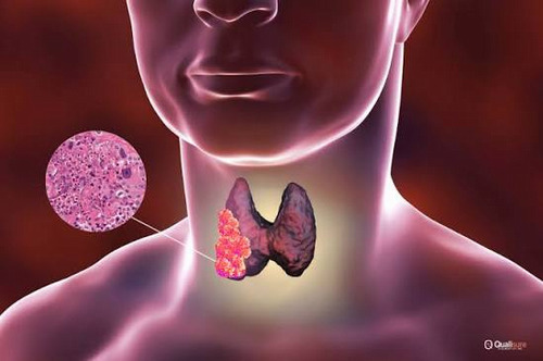 Immunohistochemical analysis reveals increased active GSK3 and inactive PP2A levels in anaplastic thyroid cancer
